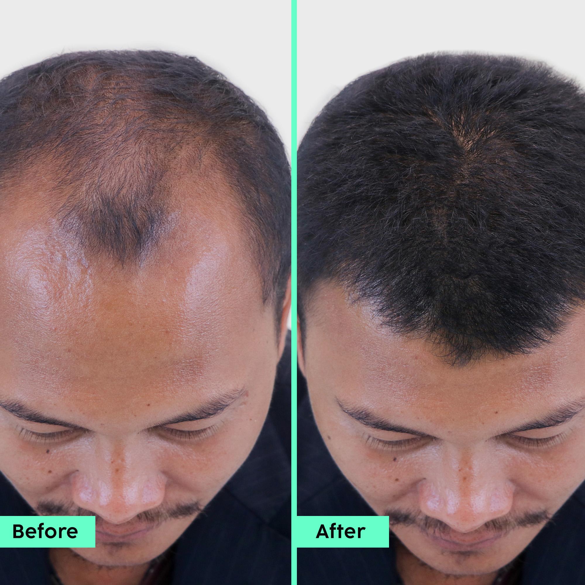 Anti-Hair Fall Advanced Serum & Shampoo Anti-Hair Fall Advanced Serum & Shampoo