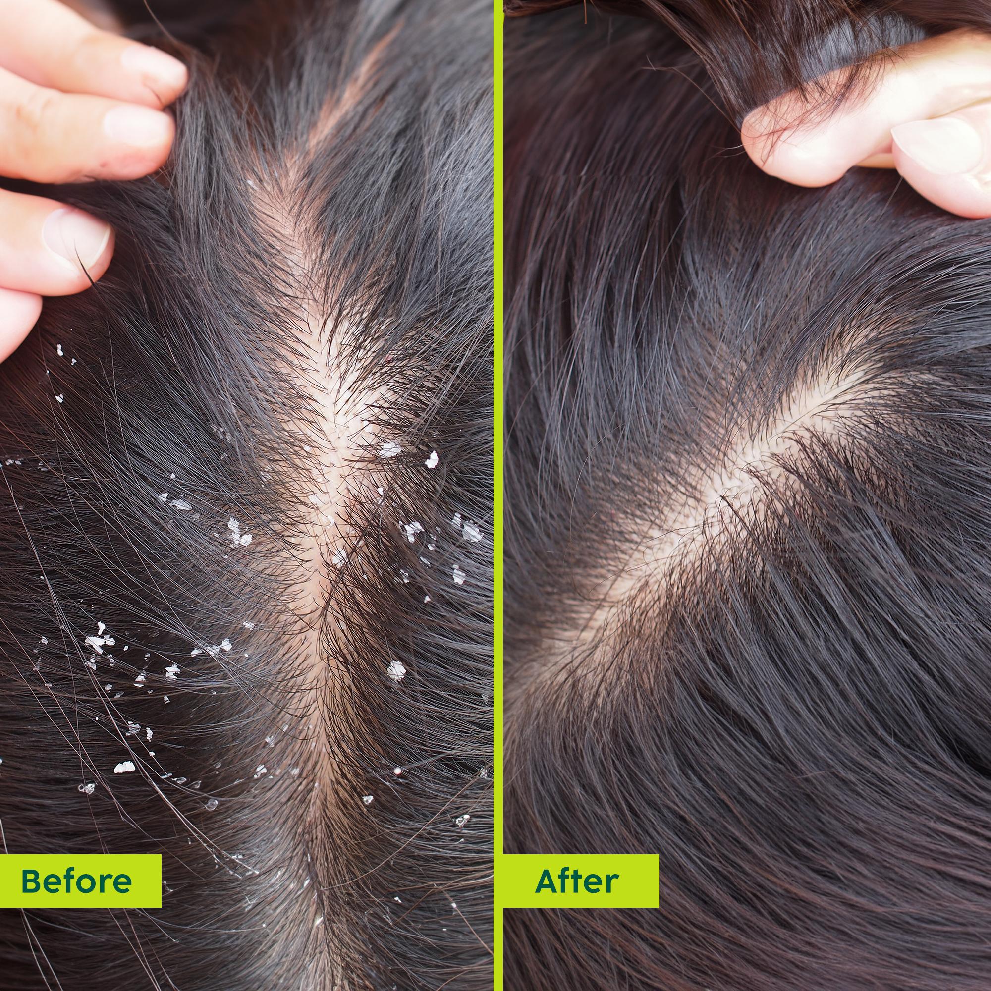 Anti-Dandruff Hair Oil for Scalp Relief & Texture