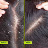 Anti-Dandruff Hair Oil for Scalp Relief & Texture