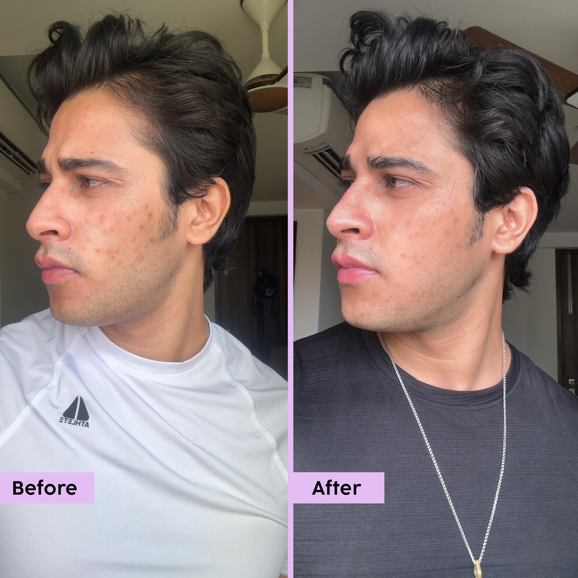 Niacinamide Face Serum for Blemish & Acne Mark Removal