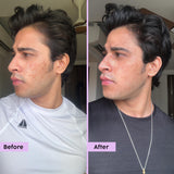 Niacinamide Face Serum for Blemish & Acne Mark Removal