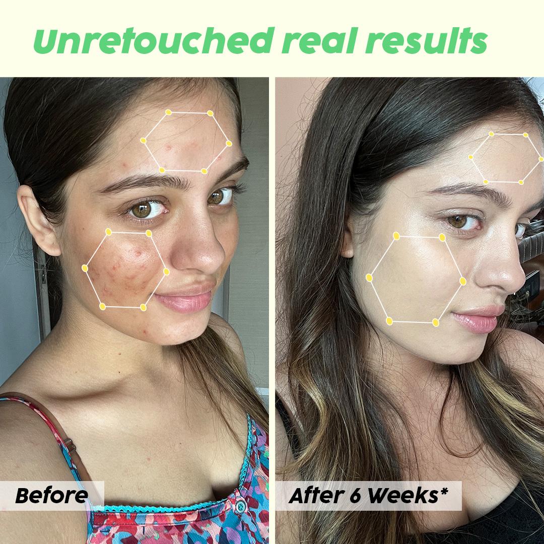 Niacinamide Face Serum for Blemish & Acne Mark Removal