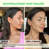 Niacinamide Face Serum for Blemish & Acne Mark Removal