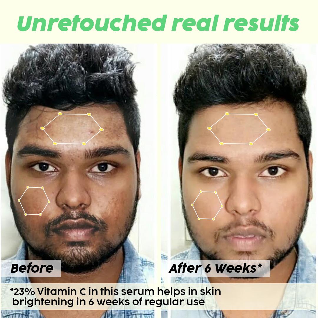 ચમકદાર ત્વચા માટે વિટામિન C ફેસ સીરમ