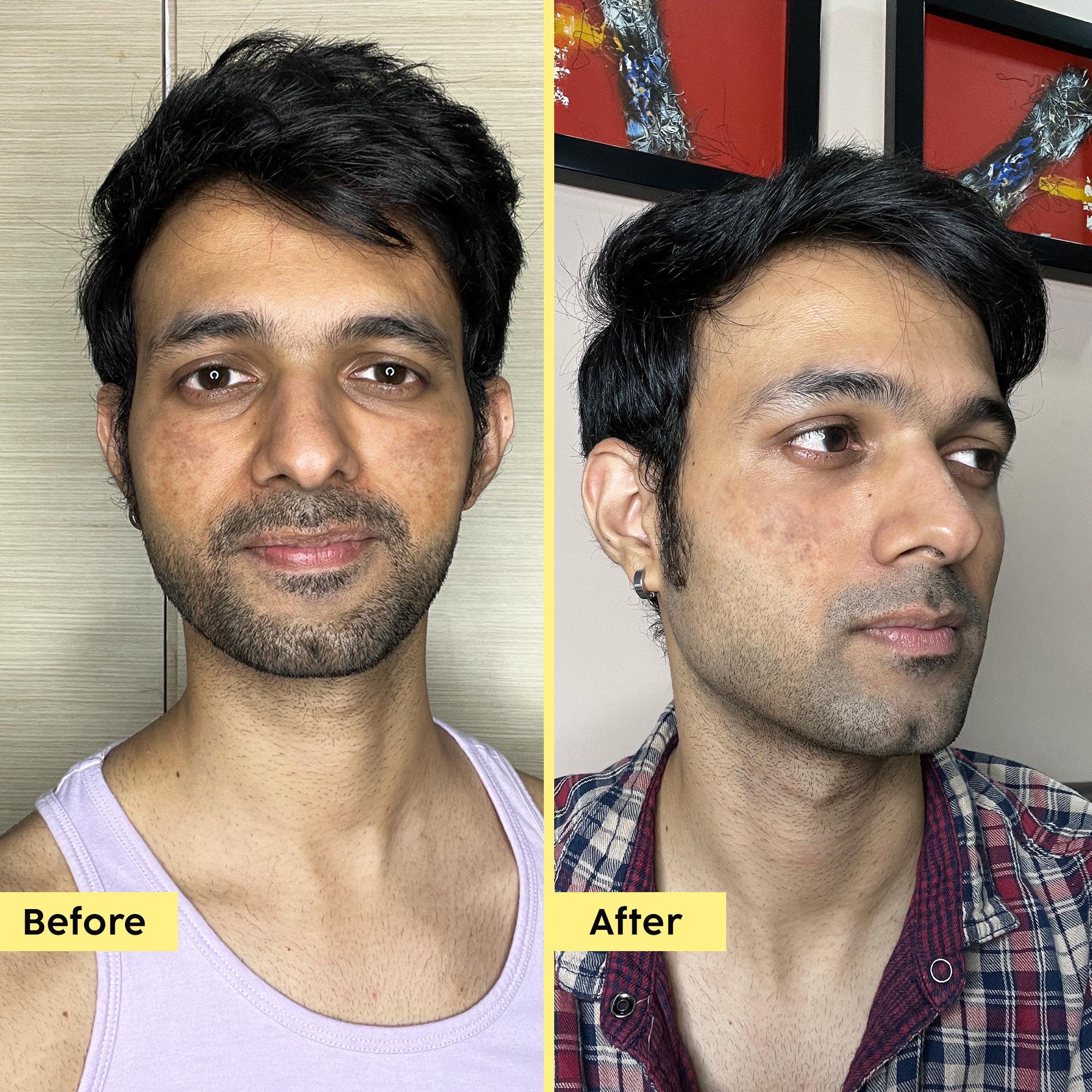 Pineapple De-pigmentation Facewash with Niacinamide