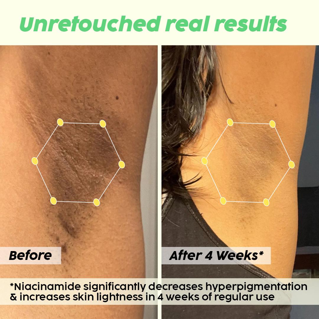 Underarm Depigmentation Serum for Brighter Skin