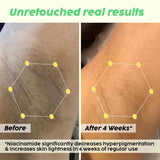 Underarm Depigmentation Serum for Brighter Skin