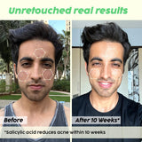 Salicylic Acid Cleanser for Acne Prone Skin