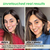 Niacinamide Moisturizer for Acne Control