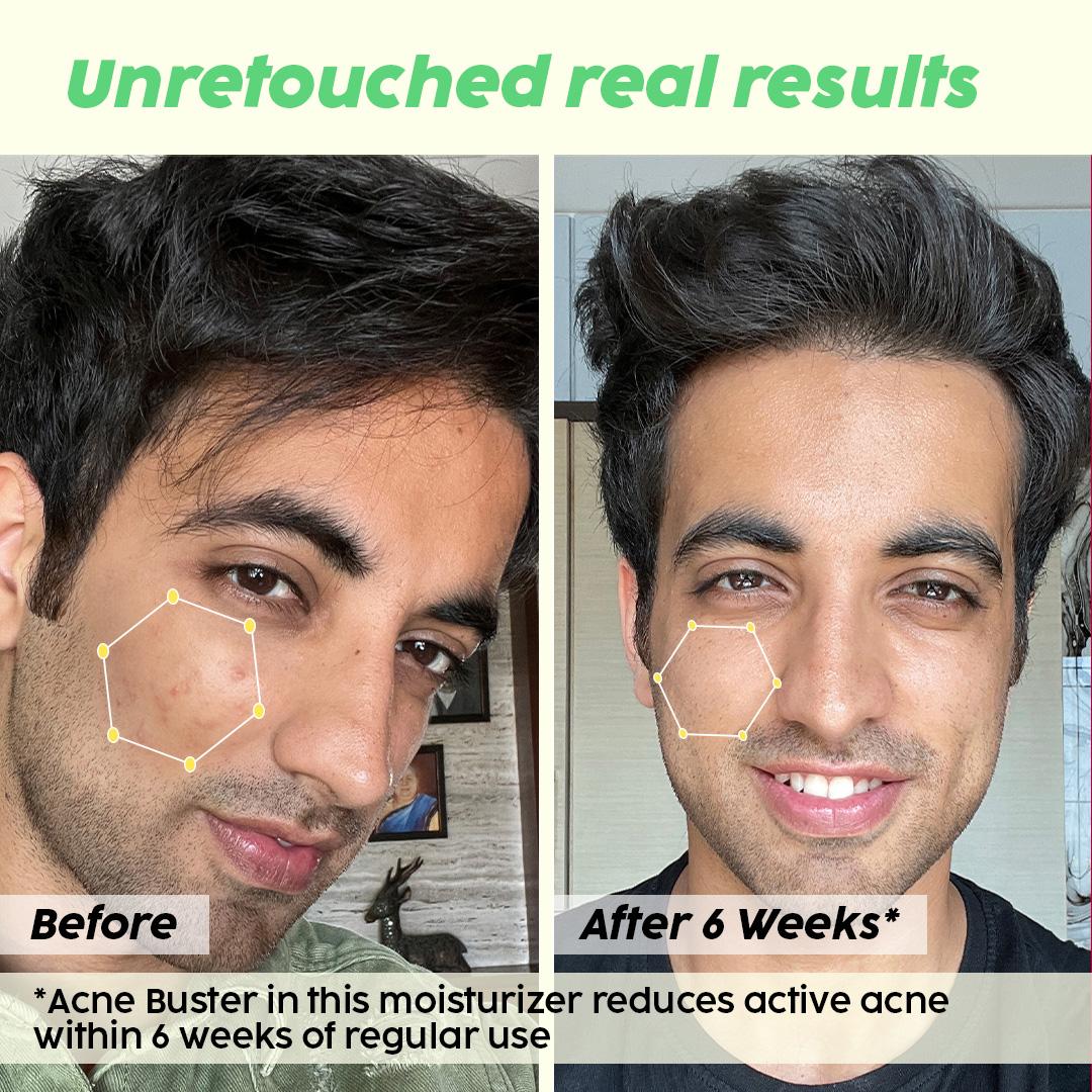 Niacinamide Moisturizer for Acne Control