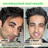 Niacinamide Moisturizer for Acne Control