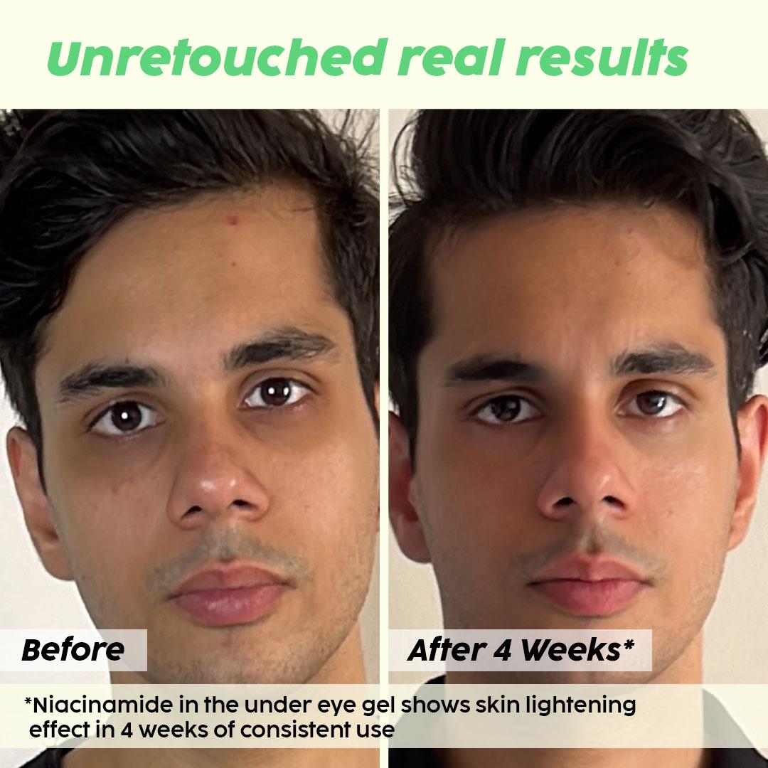 Under Eye Gel for Dark Circles and Puffiness