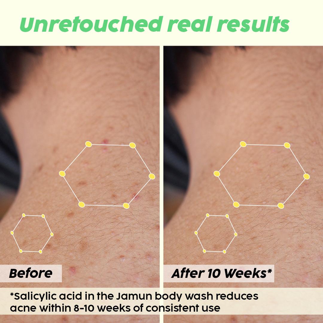 Salicylic Acid Body Wash for Clearer Skin