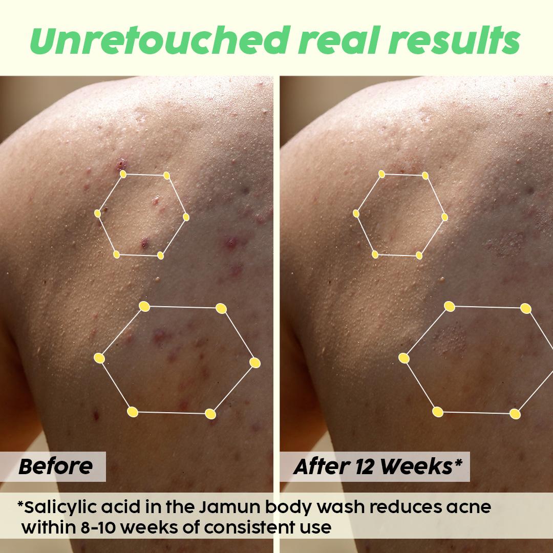 Salicylic Acid Body Wash for Clearer Skin