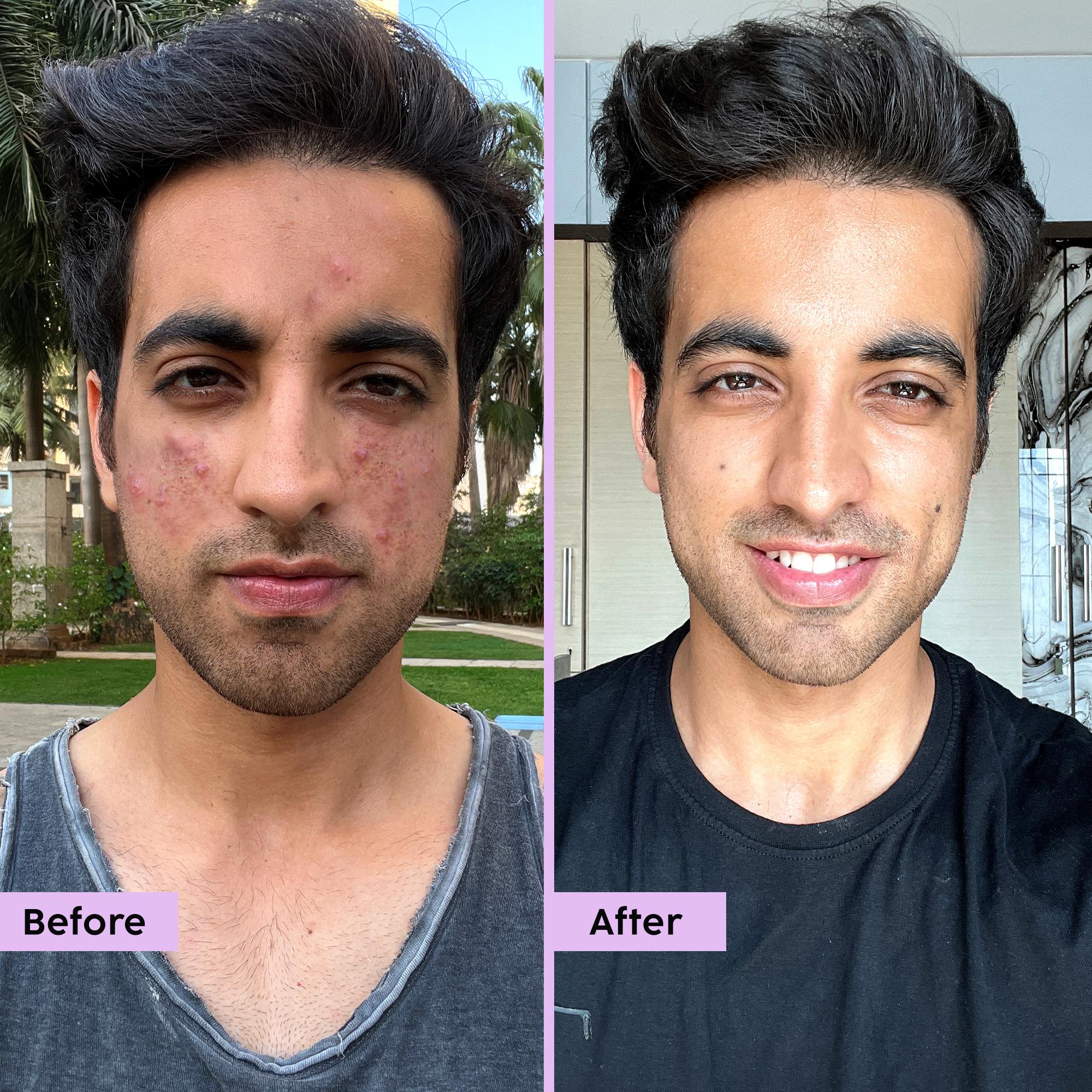 Acne Marks Regime for Blemishes & Acne
