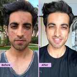 Acne Marks Regime for Blemishes & Acne
