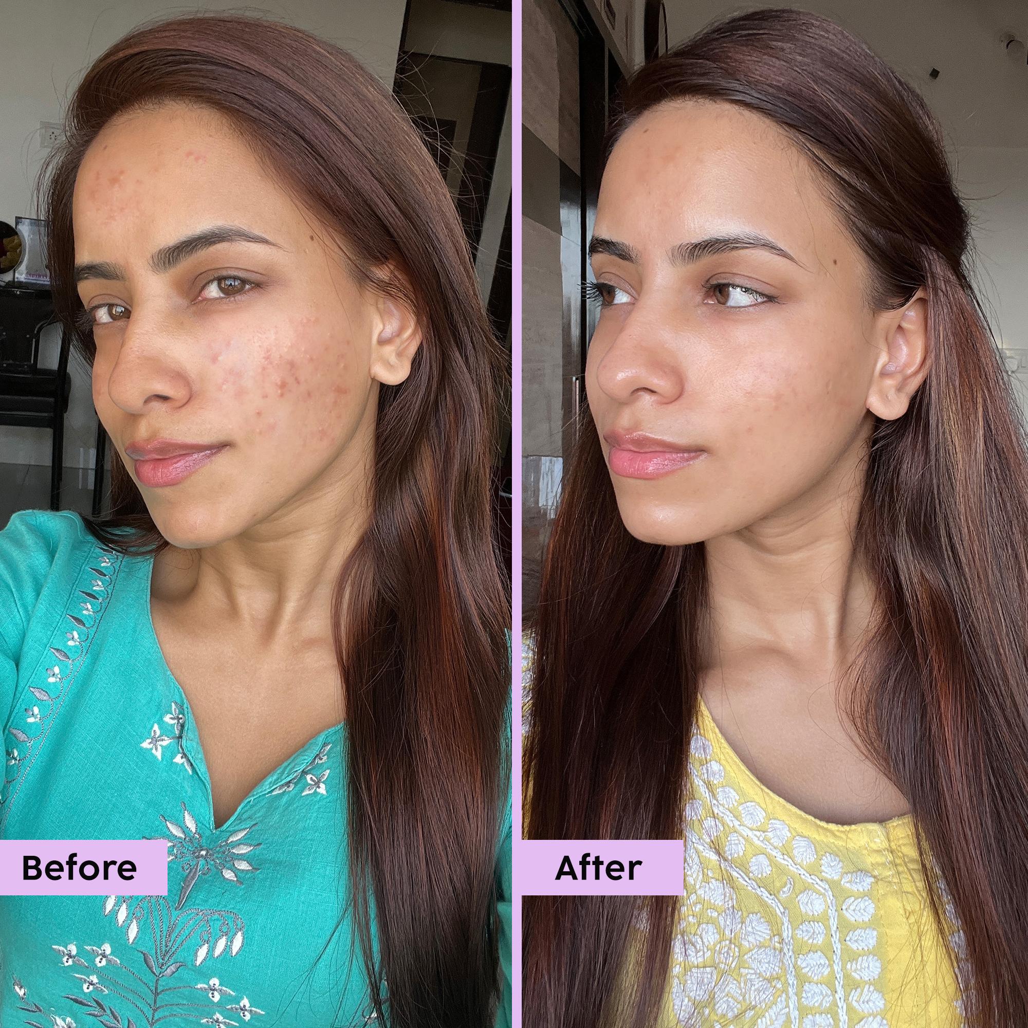Acne Marks Regime for Blemishes & Acne