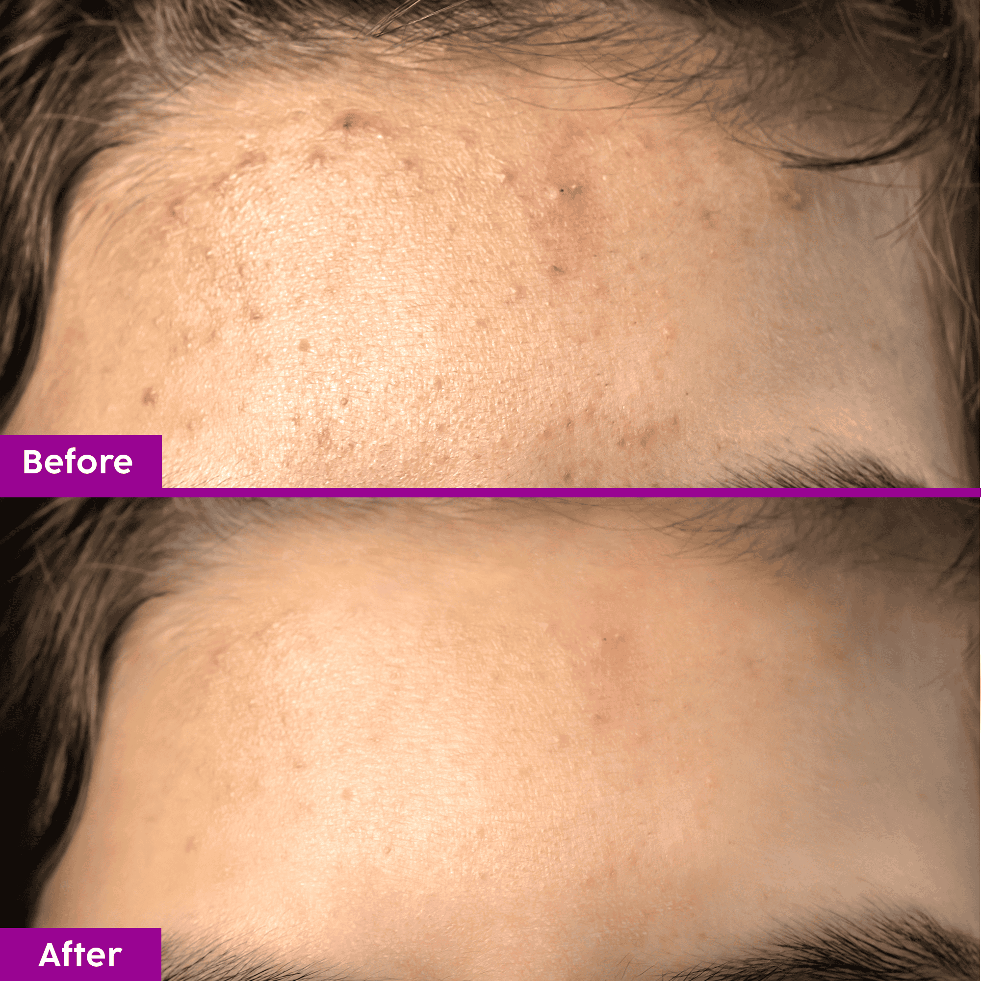 Acne Spot Corrector Gel with Salicylic Acid