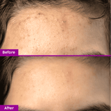 Acne Spot Corrector Gel with Salicylic Acid