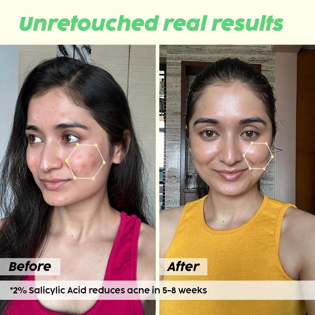 Acne Spot Corrector Gel with Salicylic Acid