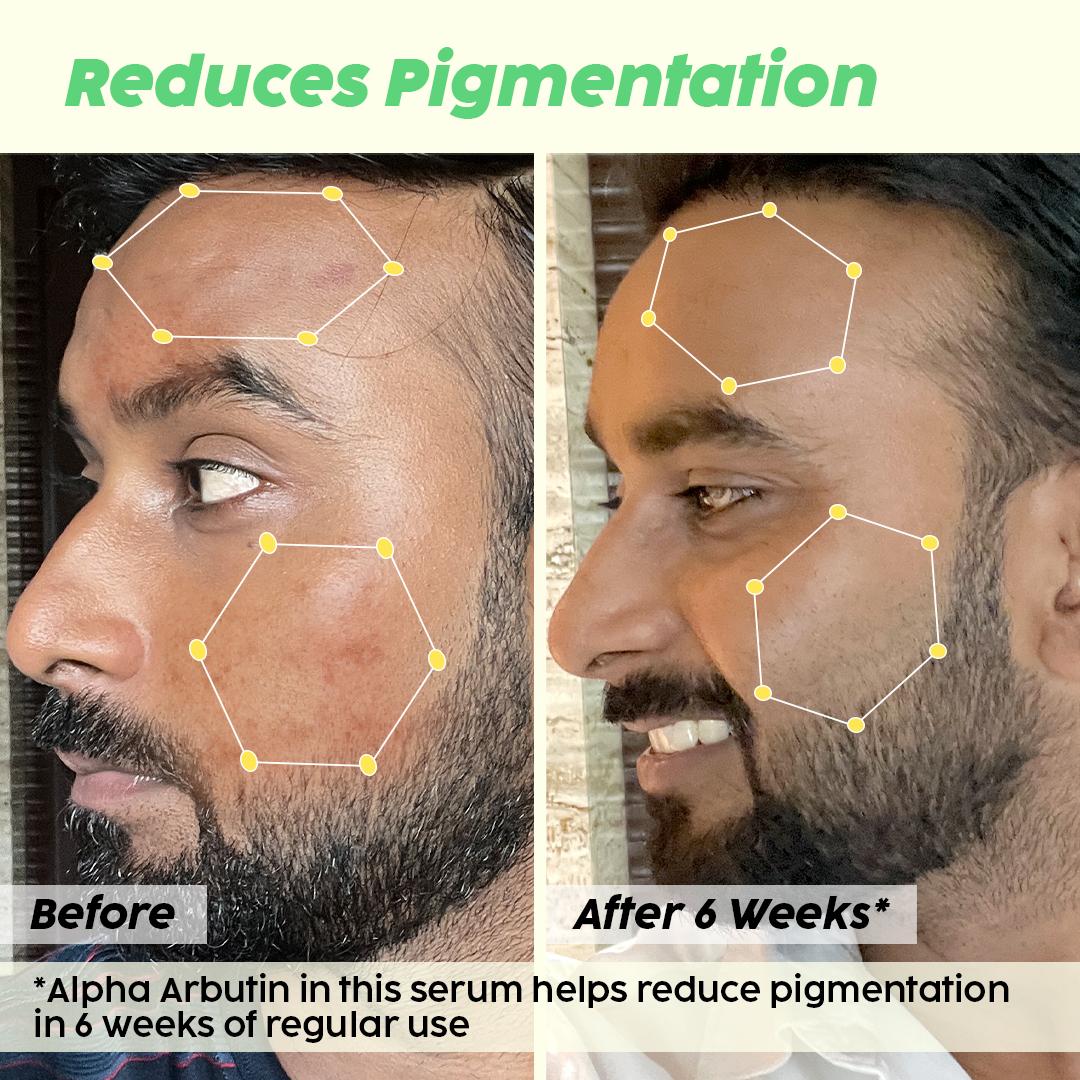 De-pigmentation Facewash, Serum & Moisturizer